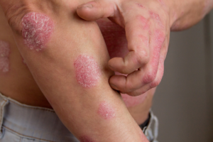 Why You Should See a Psoriatic Arthritis Specialist for Targeted, Effective Treatment Why You Should See a Psoriatic Arthritis Specialist for Targeted, Effective Treatment