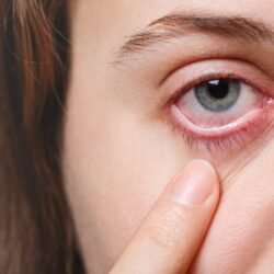 Dry Eyes Optometrist Mississauga