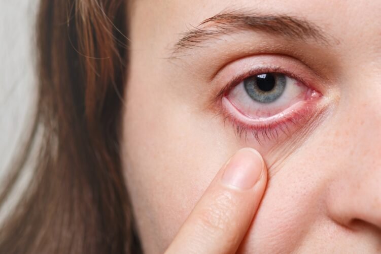 Dry Eyes Optometrist Mississauga