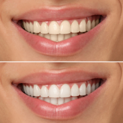 Teeth Whitening NJ