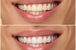 Why are more people choosing Teeth Whitening NJ for quick and long-lasting whitening results Why are more people choosing Teeth Whitening NJ for quick and long-lasting whitening results