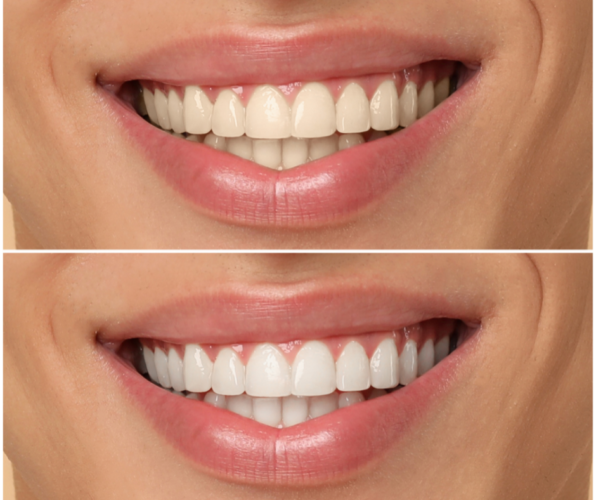Teeth Whitening NJ