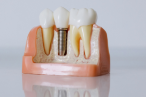 The Science Behind Natural-Looking Dental Implants and Long-Term Functional Smile Rehabilitation
