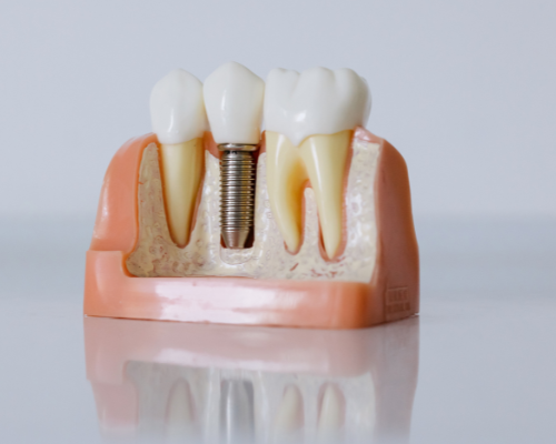 The Science Behind Natural-Looking Dental Implants and Long-Term Functional Smile Rehabilitation Dental Implants